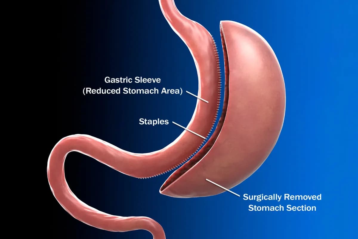 Gastric Sleeve